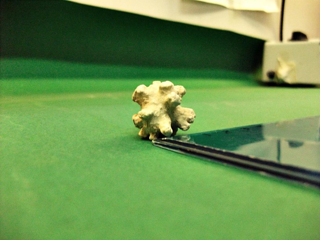 Calcolo corallo o "a corna di cervo"